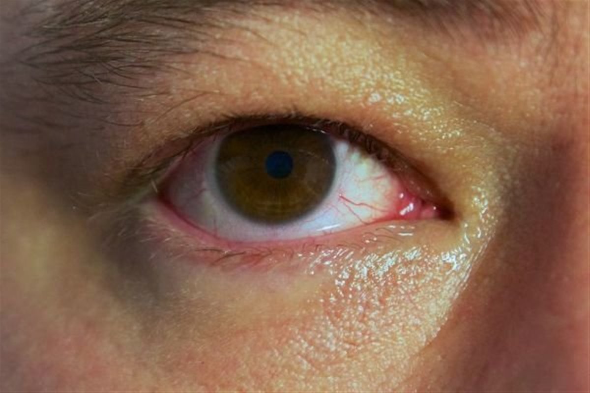 ویروس هپاتیت B موجب از بین رفتن بینایی می شود