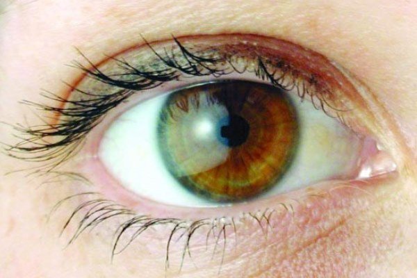 ویتامین A به درمان نابینایی ناشی از دیابت کمک می کند