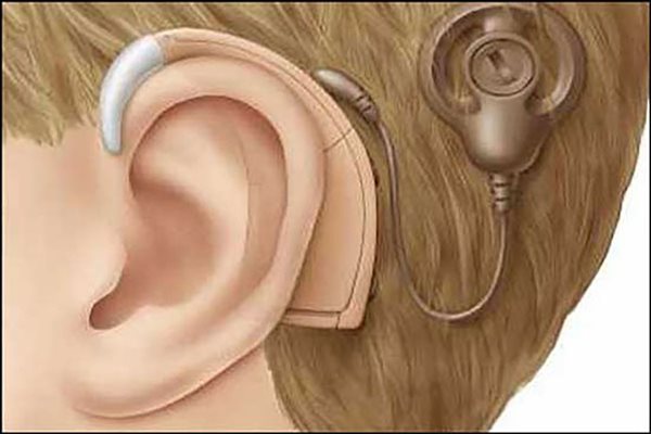 خبر خوش برای بیماران نیازمند کاشت حلزون شنوایی